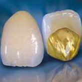  Металлокерамические зубные коронки